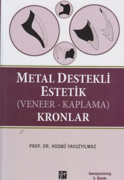Metal Destekli Estetik (Veneer-Kaplama) Kronlar Metal Destekli Estetik (Veneer-Kaplama) Kronlar