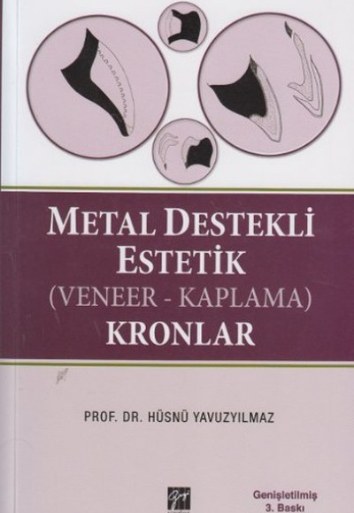 Metal Destekli Estetik (Veneer-Kaplama) Kronlar